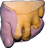 Großzehenersatz aus Silikon